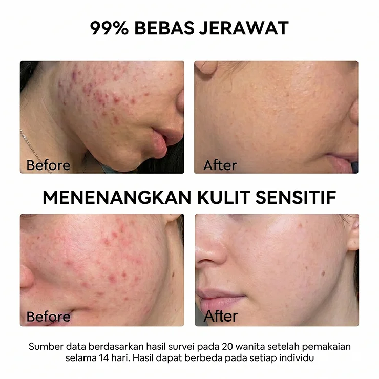 DERMASTORY Sabun Cuci Muka Jerawat Acne Clarifying Gentle Facial Wash 100ml - Gambar 3